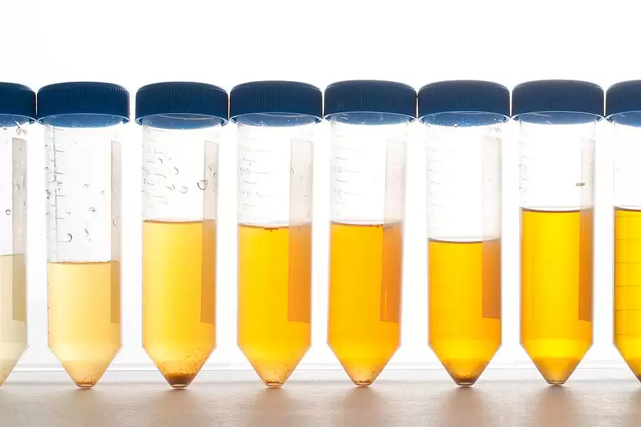 A cor da urina pode revelar doenças